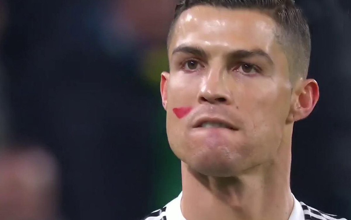 السر الكامل وراء العلامات الحمراء على وجوه لاعبي الدوري الإيطالي